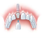 Single Tooth Implant