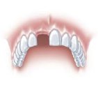 Single Tooth Implant